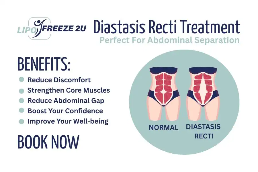 Benefits of body toning treatment Chiswick for Diastasis recti