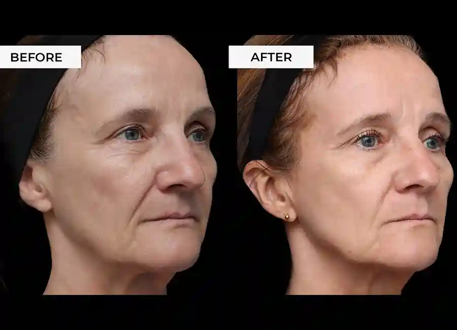 How Many RF Microneedling Sessions Will You Need to See a Difference Chiswick?