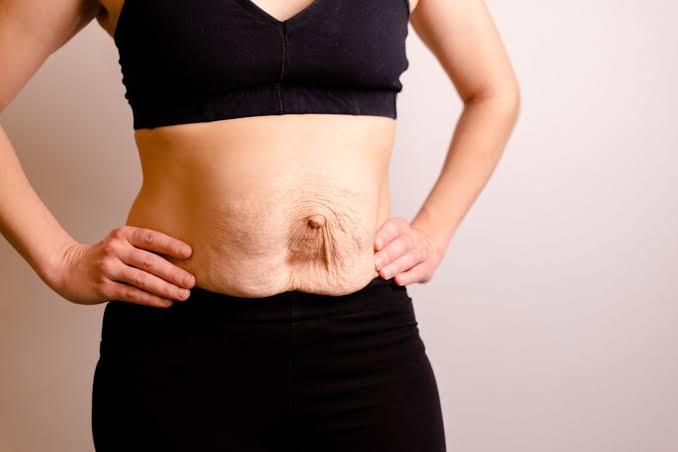 Is Surgery Really the Only Way to Repair Diastasis Recti Chiswick?