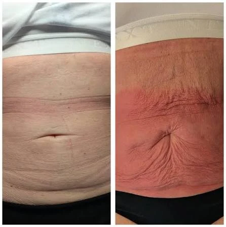 How Does RF Microneedling Improve Crepey, Thin and Uneven Skin Texture Chiswick?