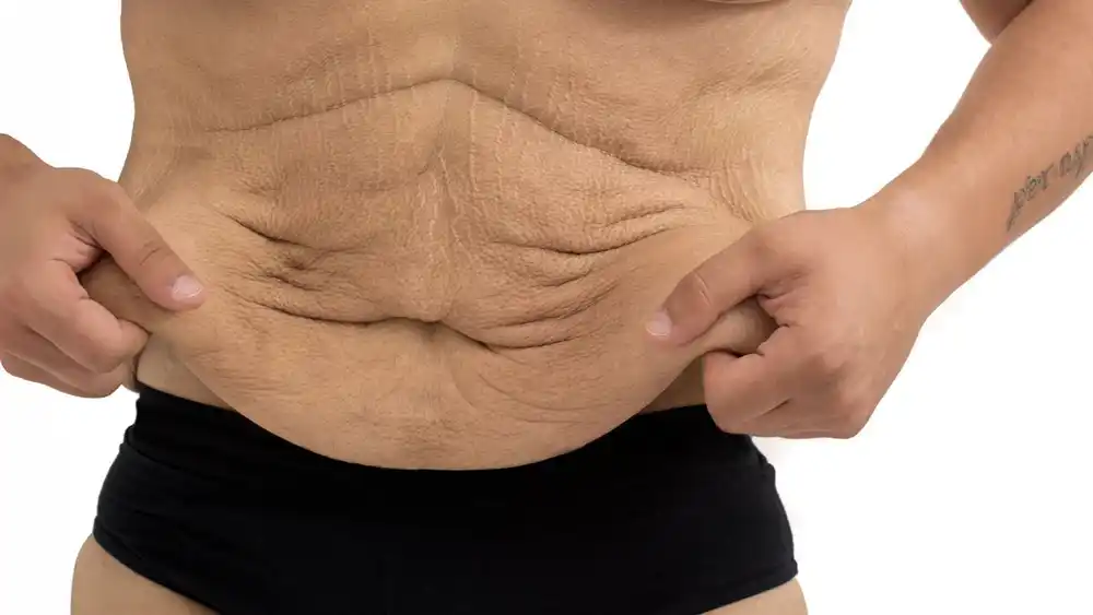 Why Does Weight Loss Medication Leave Some People With Loose or Sagging Skin Chiswick?